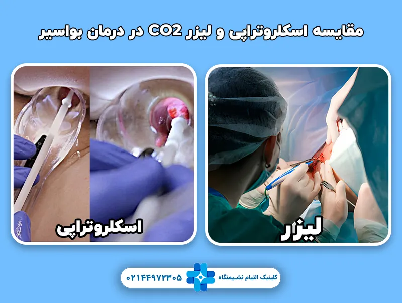 مقایسه اسکلروتراپی و لیزر CO2