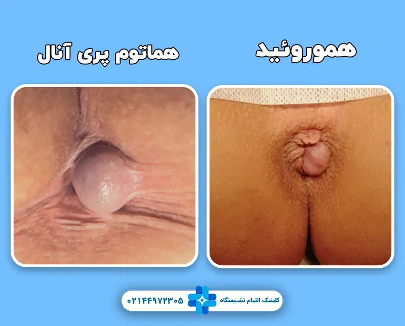 تفاوت هموروئید و هماتوم پری آنال