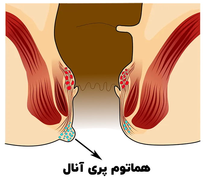 هماتوم پری آنال