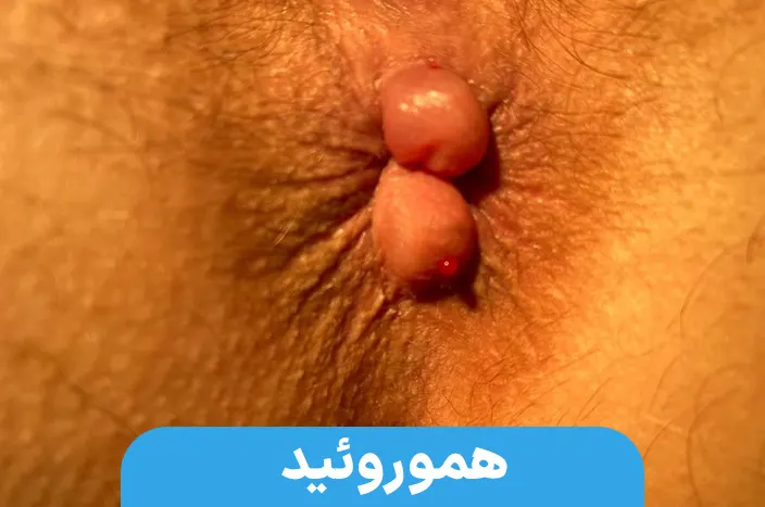 هموروئید