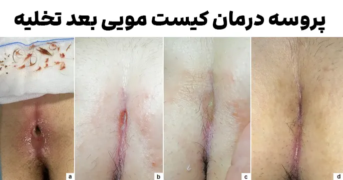 پروسه درمان کیست مویی بعد تخلیه