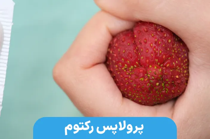 پرولاپس رکتوم