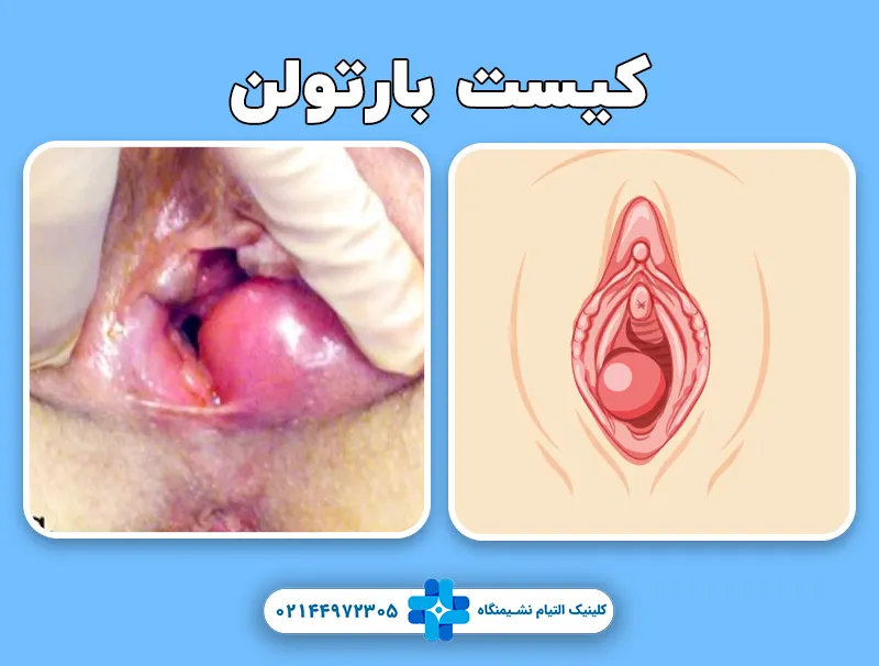 کیست بارتولن