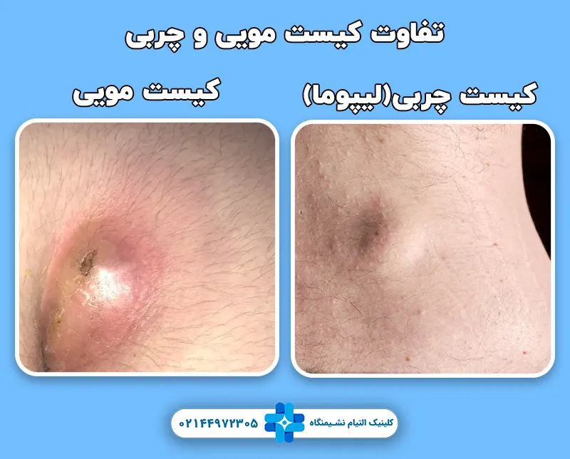 تفاوت کیست مویی با کیست چربی