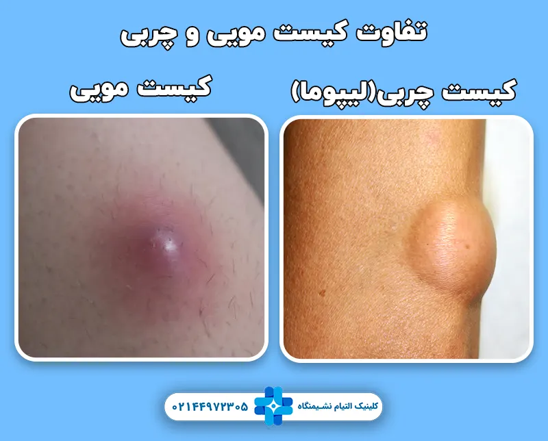 تفاوت کیست مویی با کیست چربی