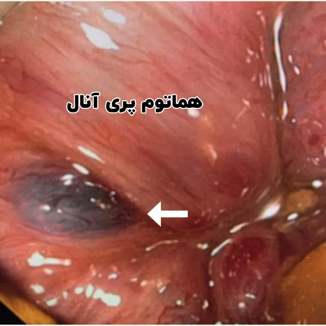 هماتوم پری آنال