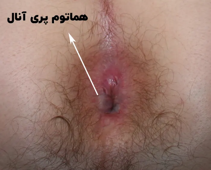 هماتوم پری آنال