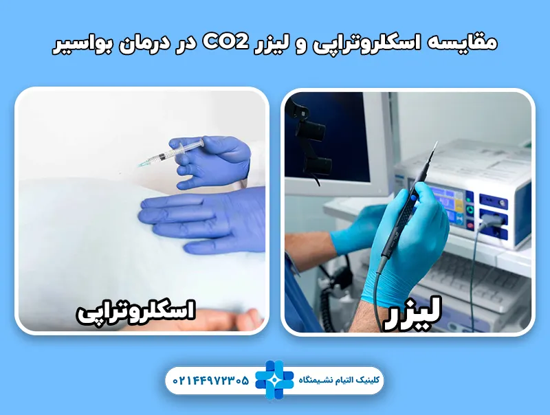 مقایسه اسکلروتراپی و لیزر CO2 در درمان بواسیر
