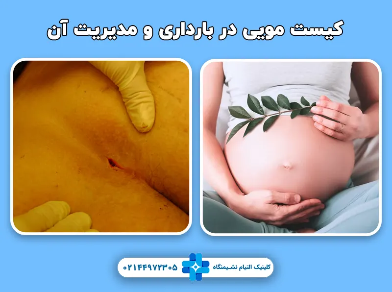 کیست مویی در بارداری