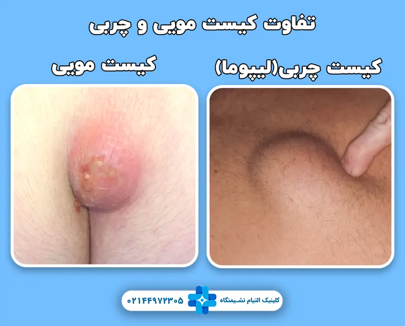 تفاوت کیست مویی با کیست چربی
