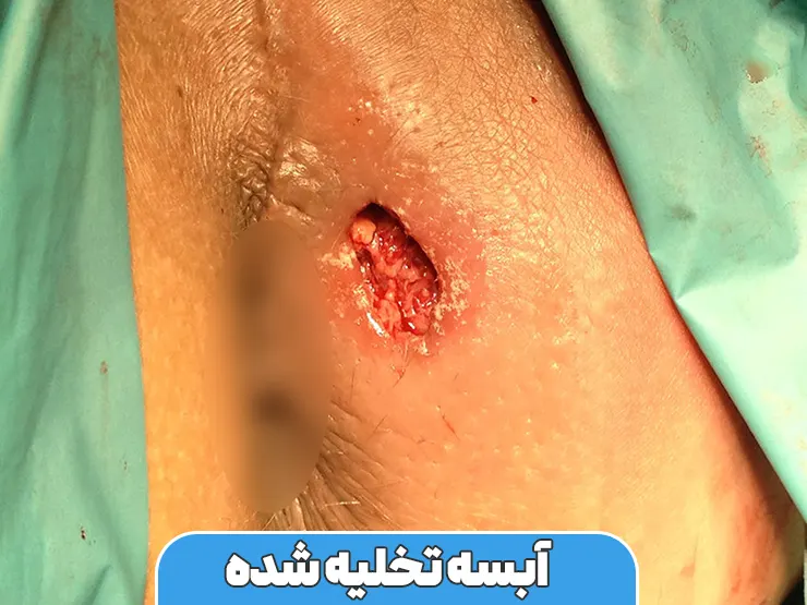 آبسه تخلیه شده