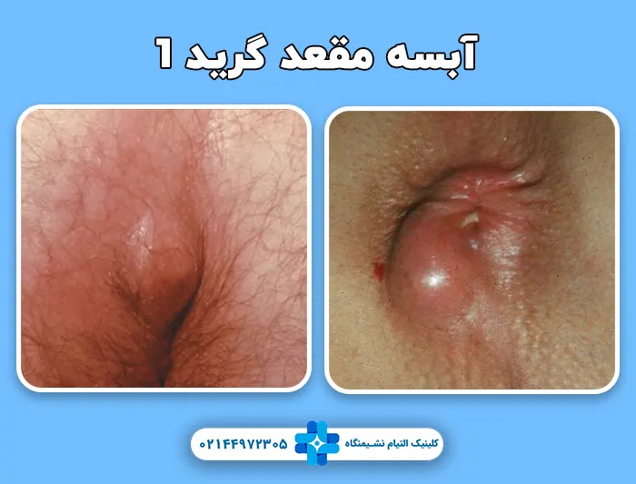 آبسه مقعدی سطحی یا گرید 1