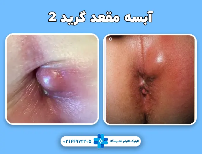 آبسه مقعدی گرید 2