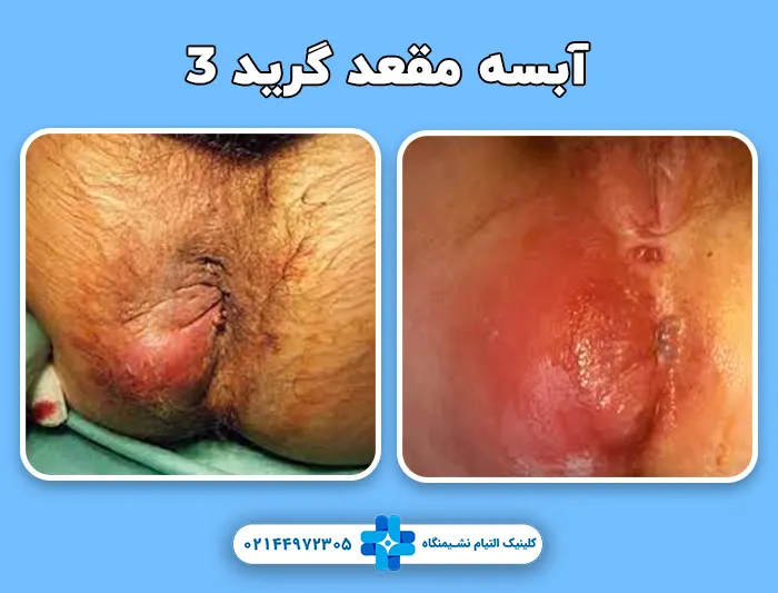 آبسه مقعدی گرید 3
