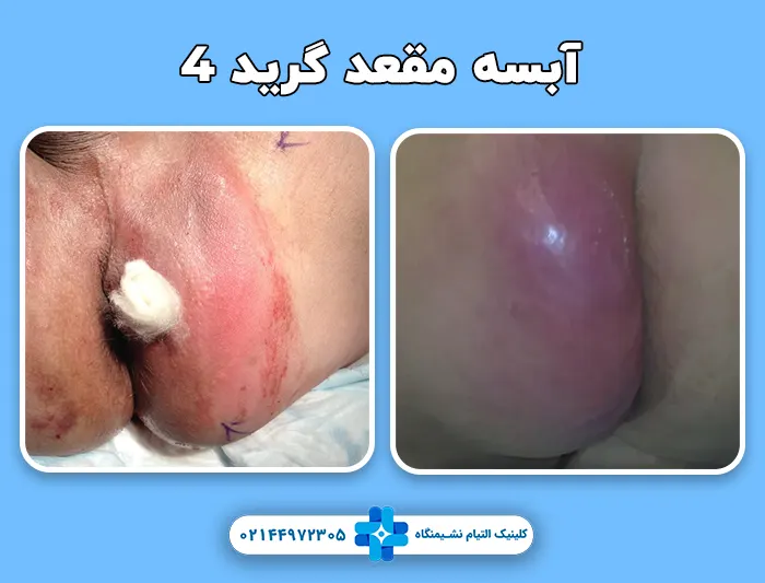 آبسه مقعد گرید 4