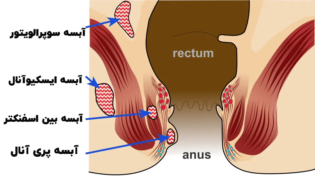 انواع آبسه مقعدی