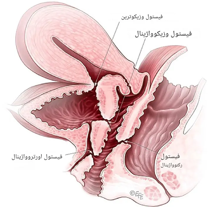 انواع فیستول واژن