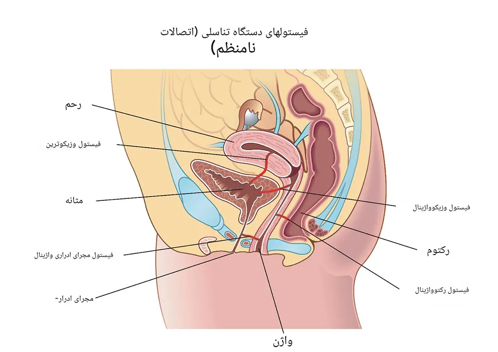 انواع فیستول واژن
