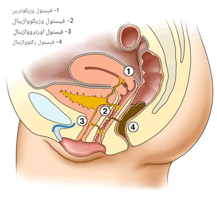 انواع فیستول واژن