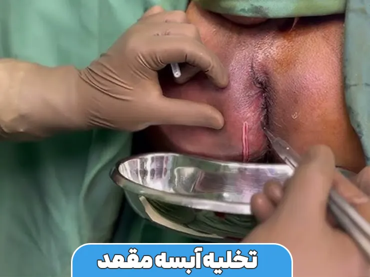 تخلیه آبسه مقعد