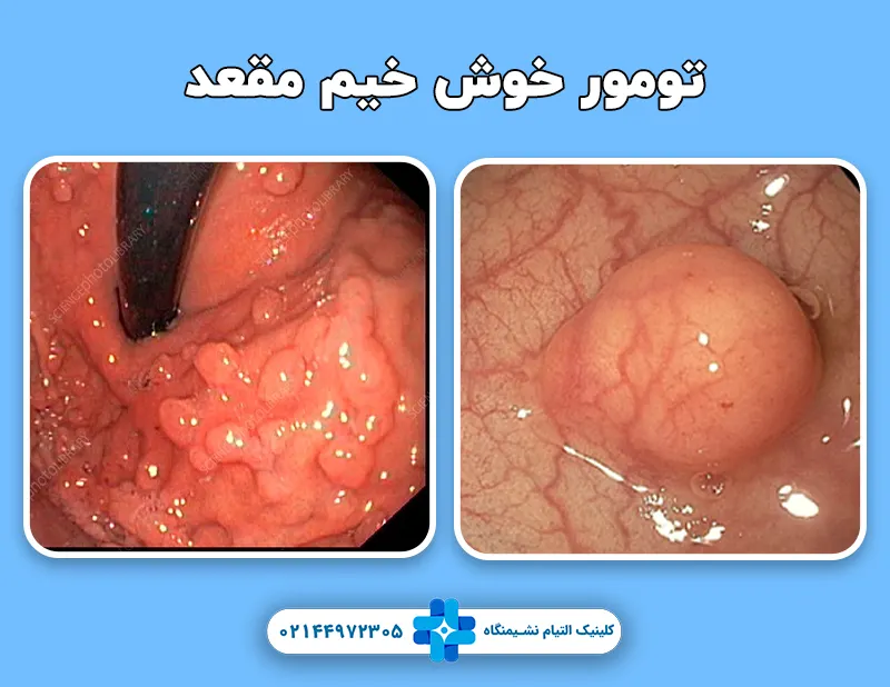 تومور خوش خیم مقعد