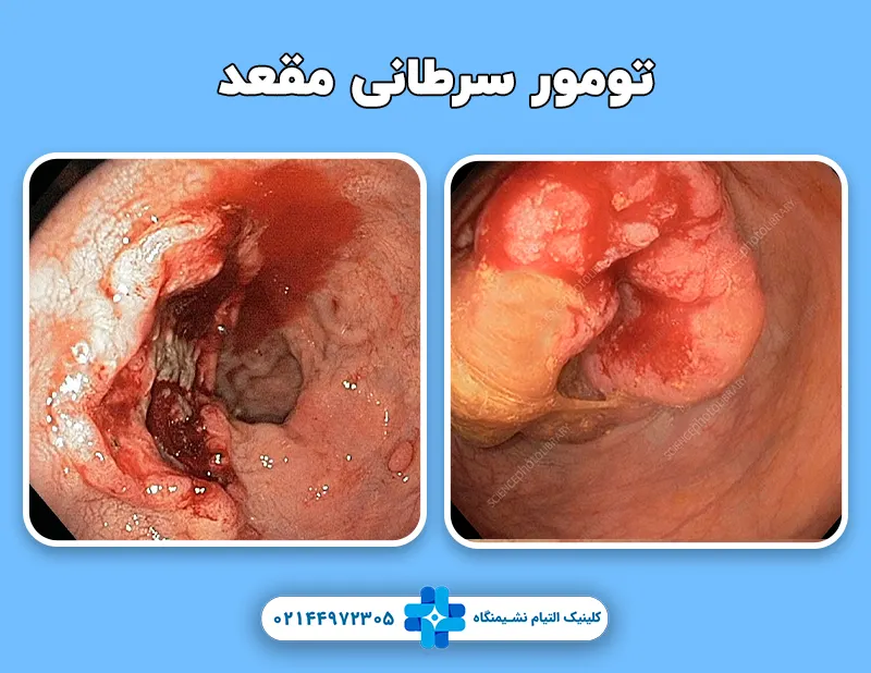 تومور سرطانی مقعد
