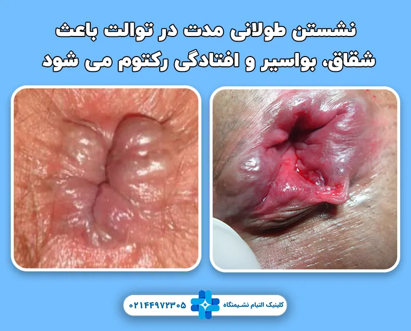 خطرات نشستن طولانی مدت در توالت