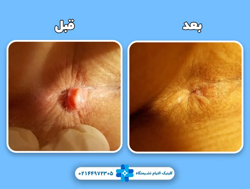 هزینه لیزر گوشت اضافه مقعدی