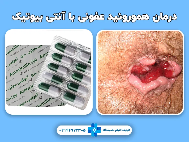 درمان هموروئید عفونی با آنتی بیوتیک