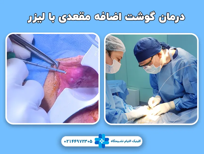 درمان گوشت اضافه مقعدی با لیزر