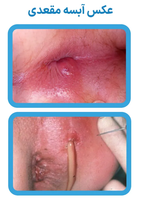 عکس آبسه مقعدی