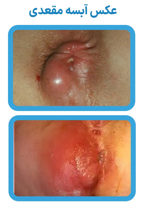 عکس آبسه مقعدی