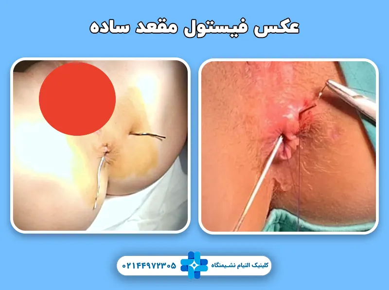 فیستول ساده