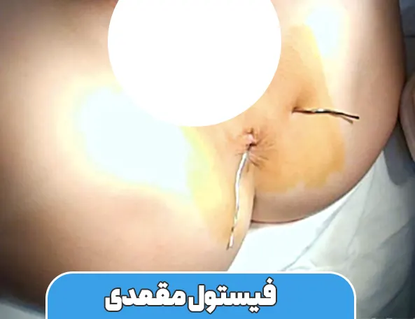 فیستول مقعدی
