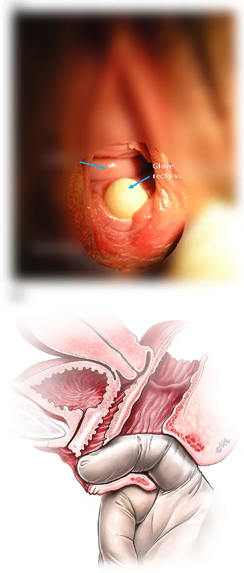 فیستول واژن