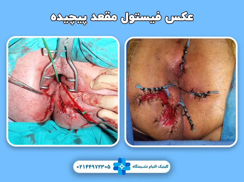 فیستول پیچیده