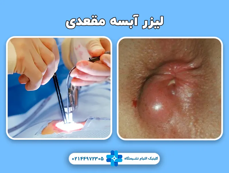 لیزر آبسه مقعدی