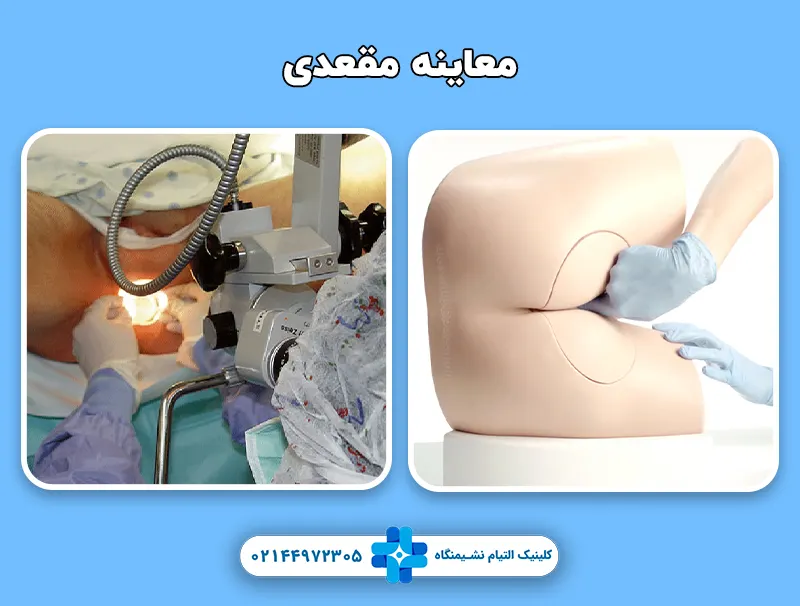 معاینه مقعدی