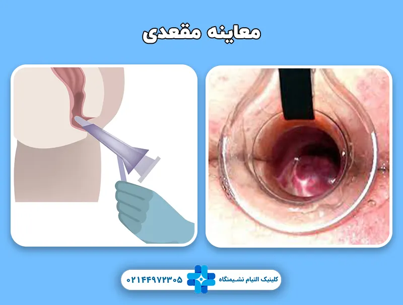 معاینه مقعدی