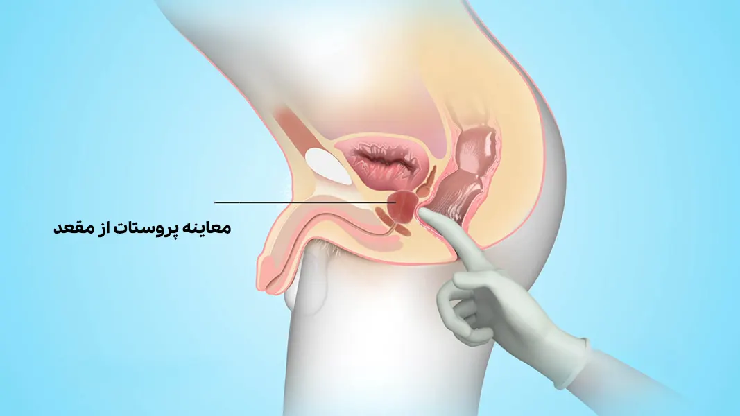 معاینه پروستات از مقعد