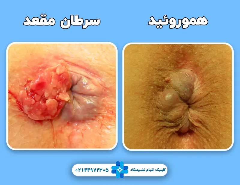 تفاوت هموروئید و سرطان مقعد