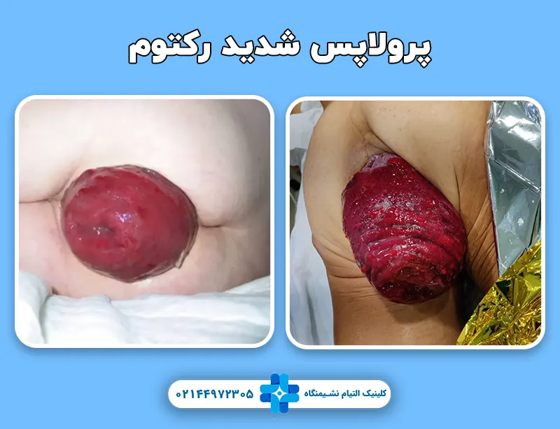 پرولاپس شدید رکتوم