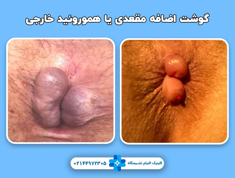 گوشت اضافه مقعدی یا هموروئید