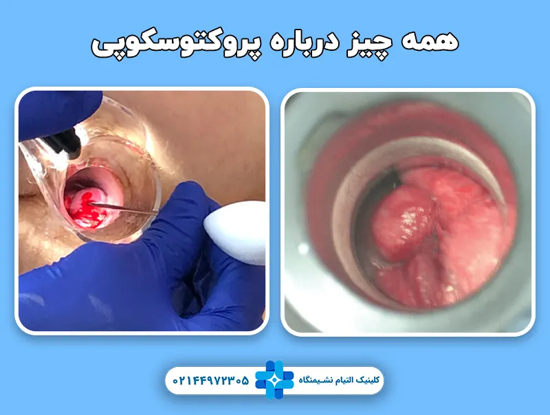 پروکتوسکوپی