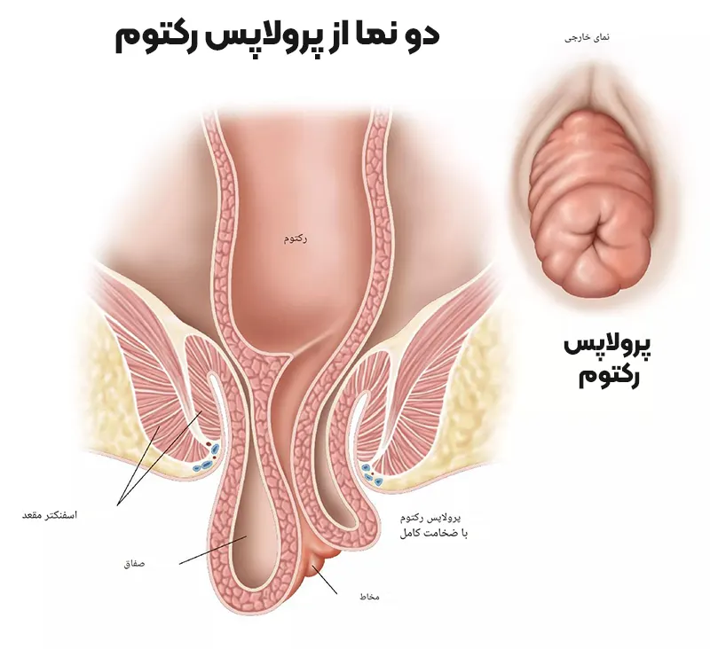 پرولاپس رکتوم چیست؟