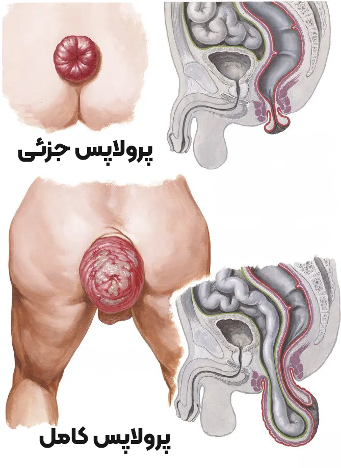 پرولاپس جزئی و پرولاپس کامل