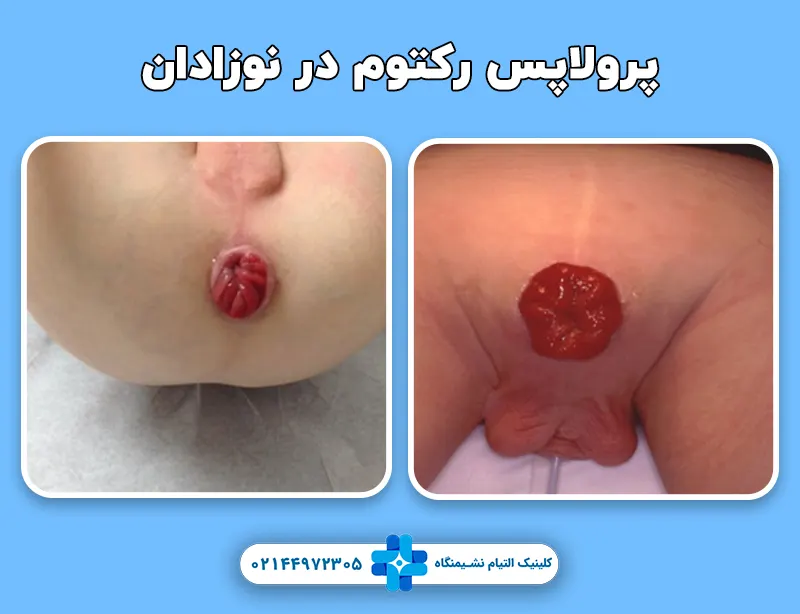 پرولاپس رکتوم در نوزادان