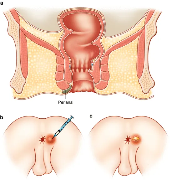 آبسه مقعدی چیست