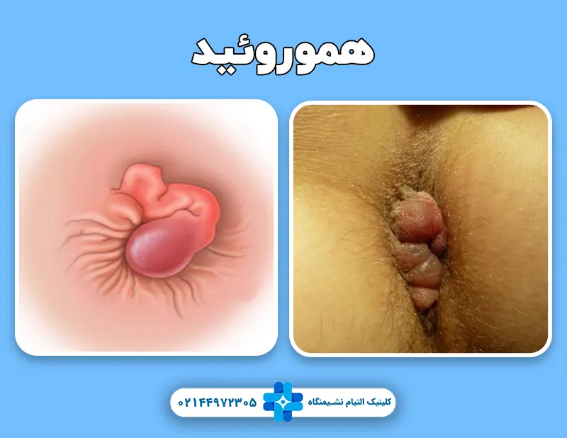 هموروئید بواسیر