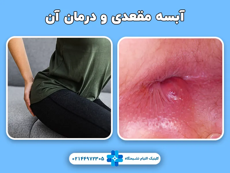 آبسه مقعدی و درمان آن